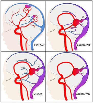Arteriovenous Cerebral High Flow Shunts in Children: From Genotype to Phenotype